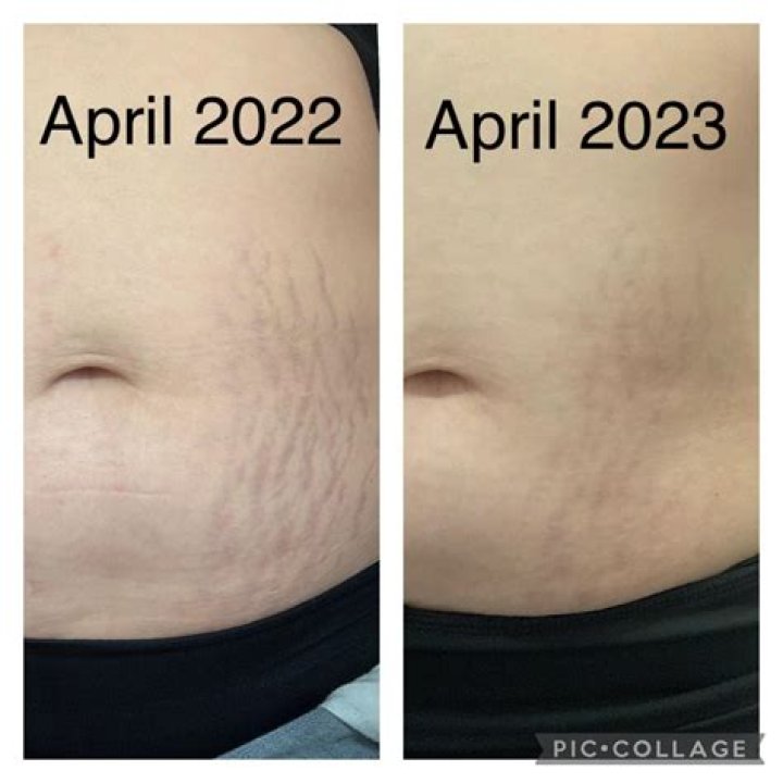 ABEX: Before & After Results - See Real Transformations!