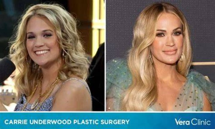 Carrie Underwood Plastic Surgery: The Truth Behind the Rumors