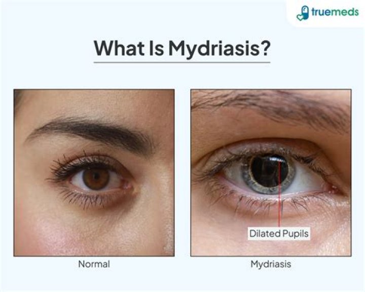 Mydriasis: Causes, Risks, and What You Need to Know - Explained